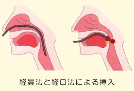 経鼻法と経口法による挿入